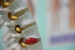 Picture of a herniated disc under michigan workers comp